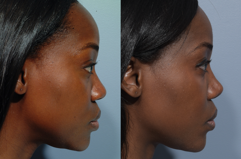 https://mdface.com/wp-content/uploads/2022/01/african-rhinoplasty-patient-4-4.png