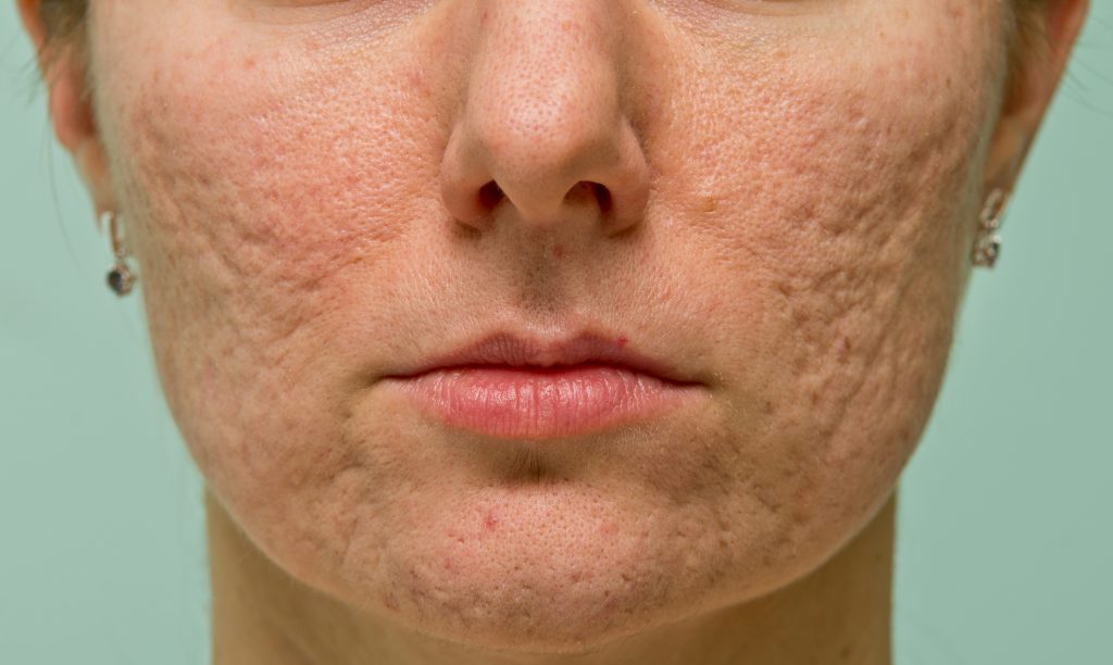 up close of woman's acne scars on face
