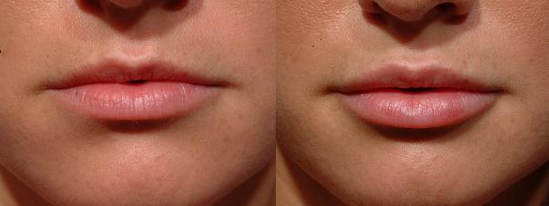 long lasting lip enhancement