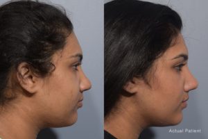 patient before and after rhinoplasty