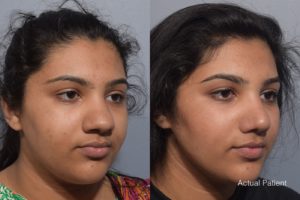 patient before and after rhinoplasty