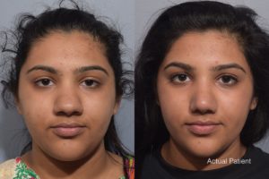 patient before and after rhinoplasty