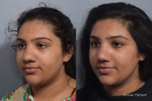 patient before and after rhinoplasty