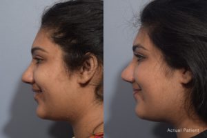 patient before and after rhinoplasty