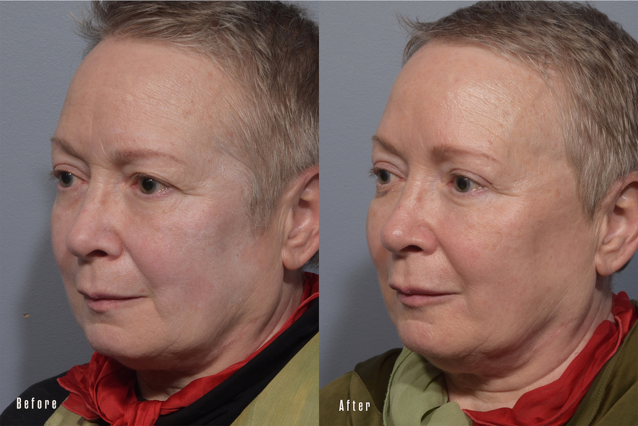 patient before and after eyelid surgery