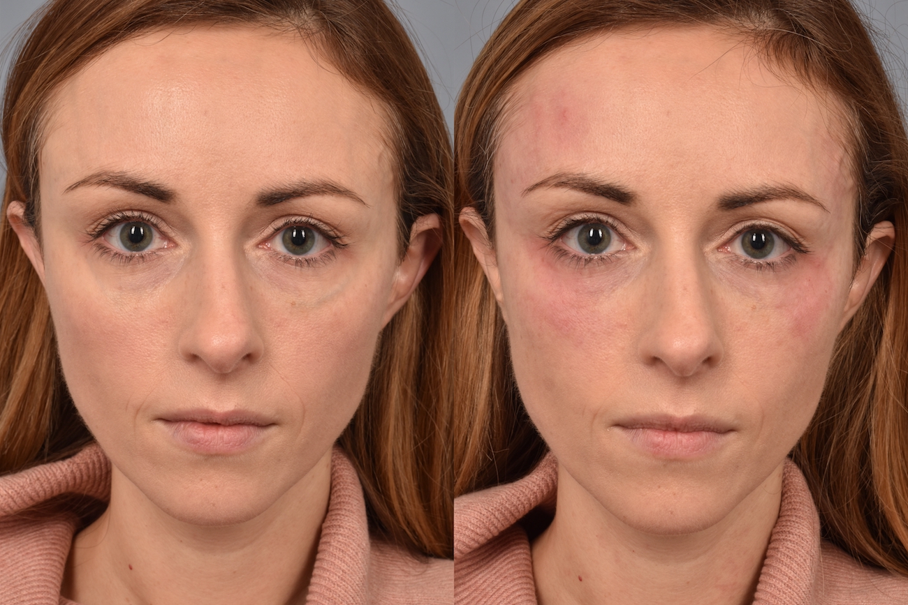 patient before and after Vascular Laser