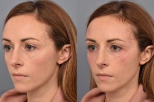 patient before and after Vascular Laser