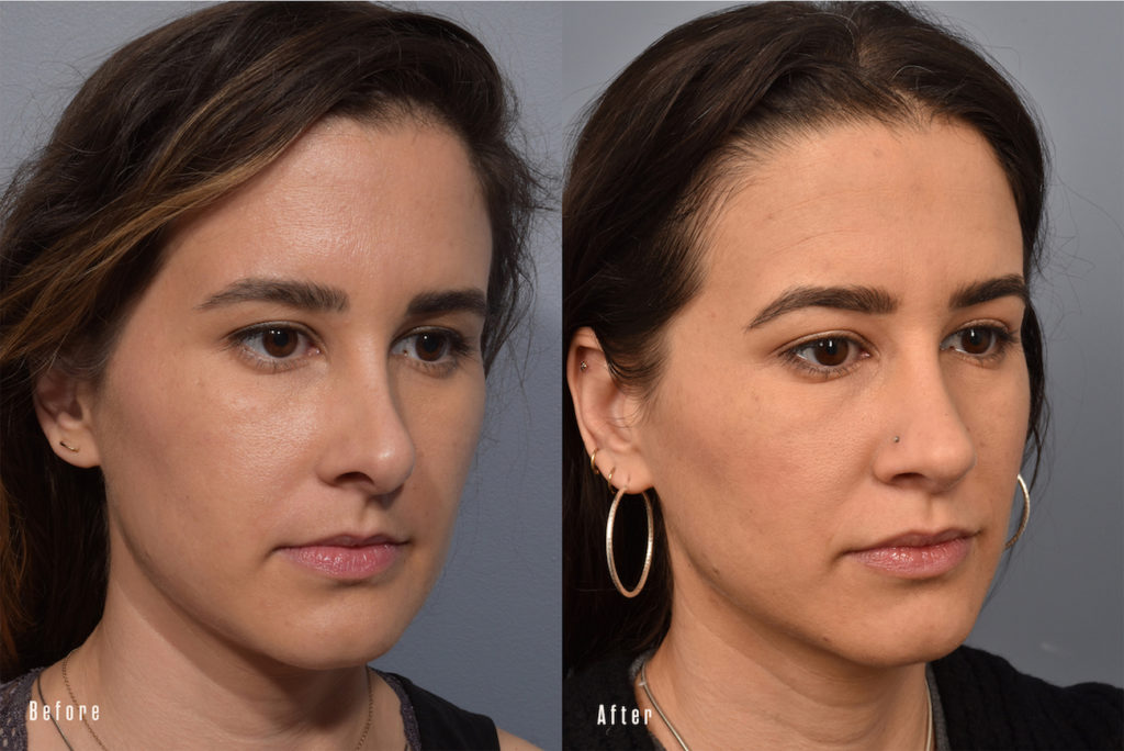 patient before and after revision rhinoplasty