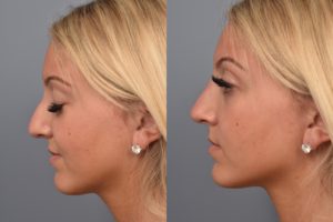 patient before and after non surgical rhinoplasty