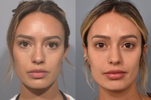 patient before and after non surgical rhinoplasty