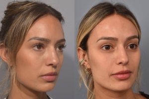 patient before and after non surgical rhinoplasty