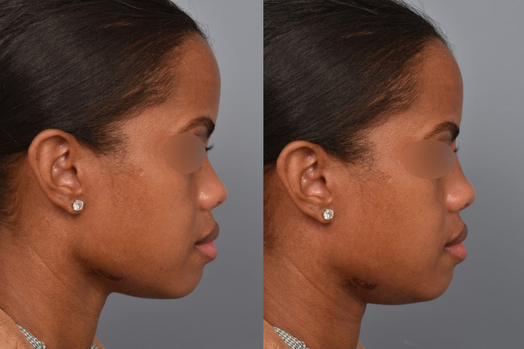 patient before and after non surgical rhinoplasty