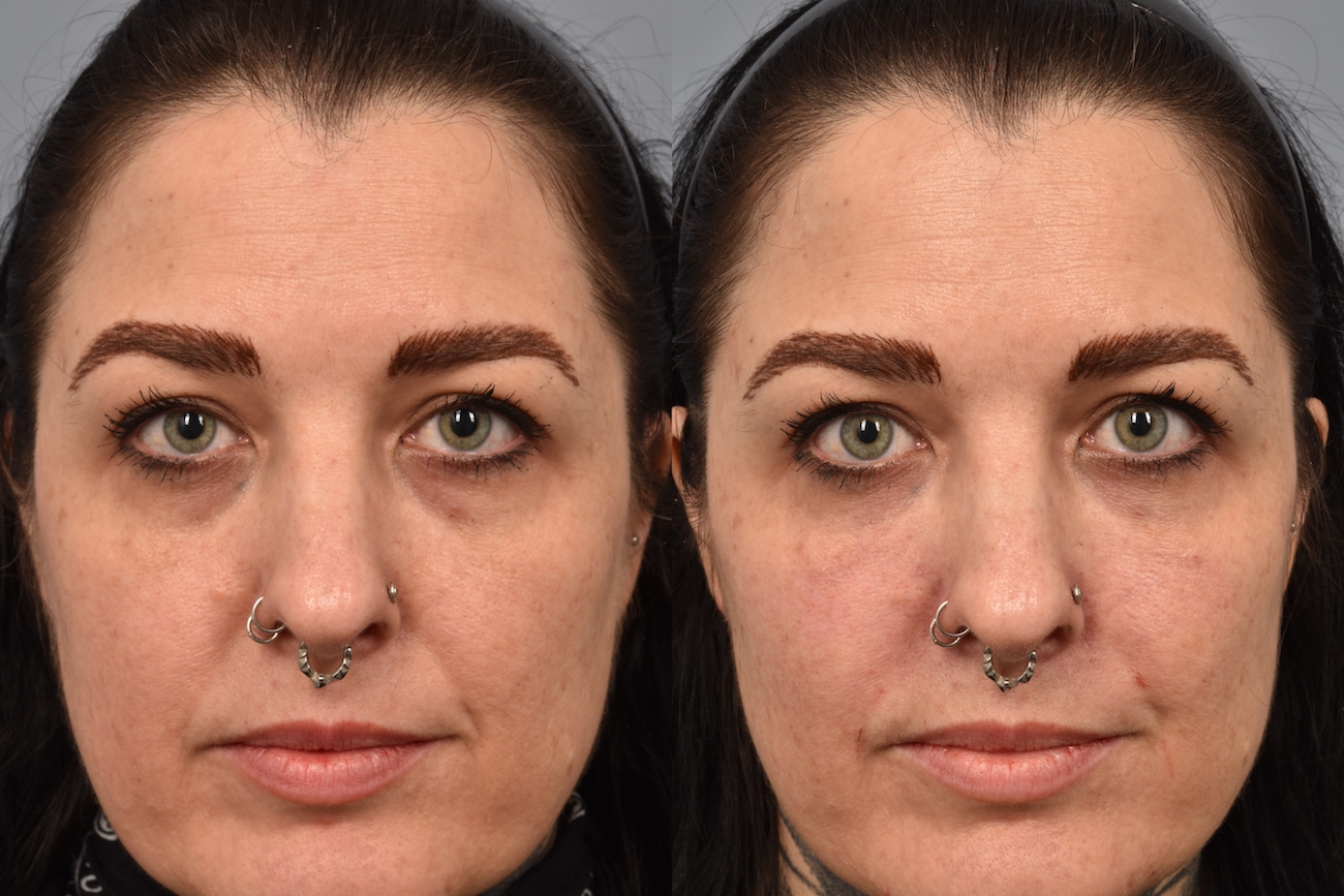 patient before and after cheek filler