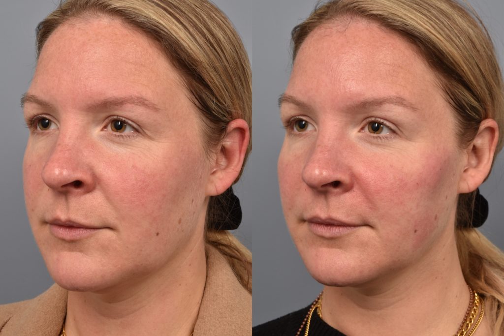 patient before and after cheek filler