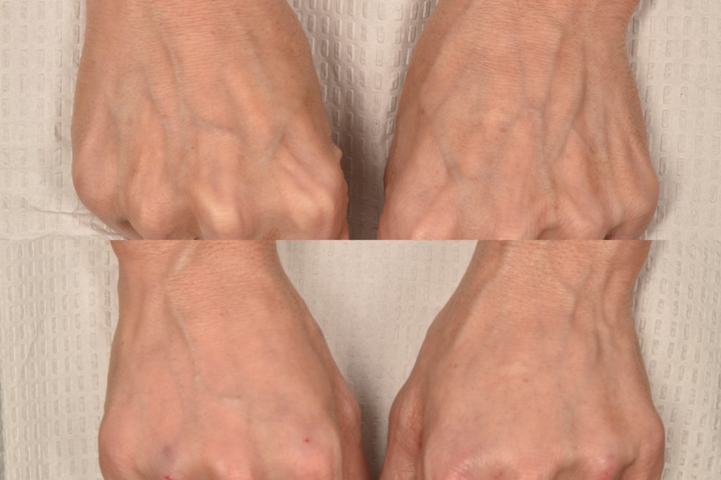 patient before and after hand filler