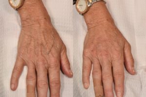 patient before and after hand filler
