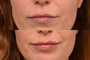 patient before and after lip filler