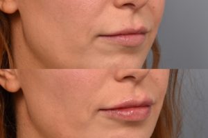 patient before and after lip filler