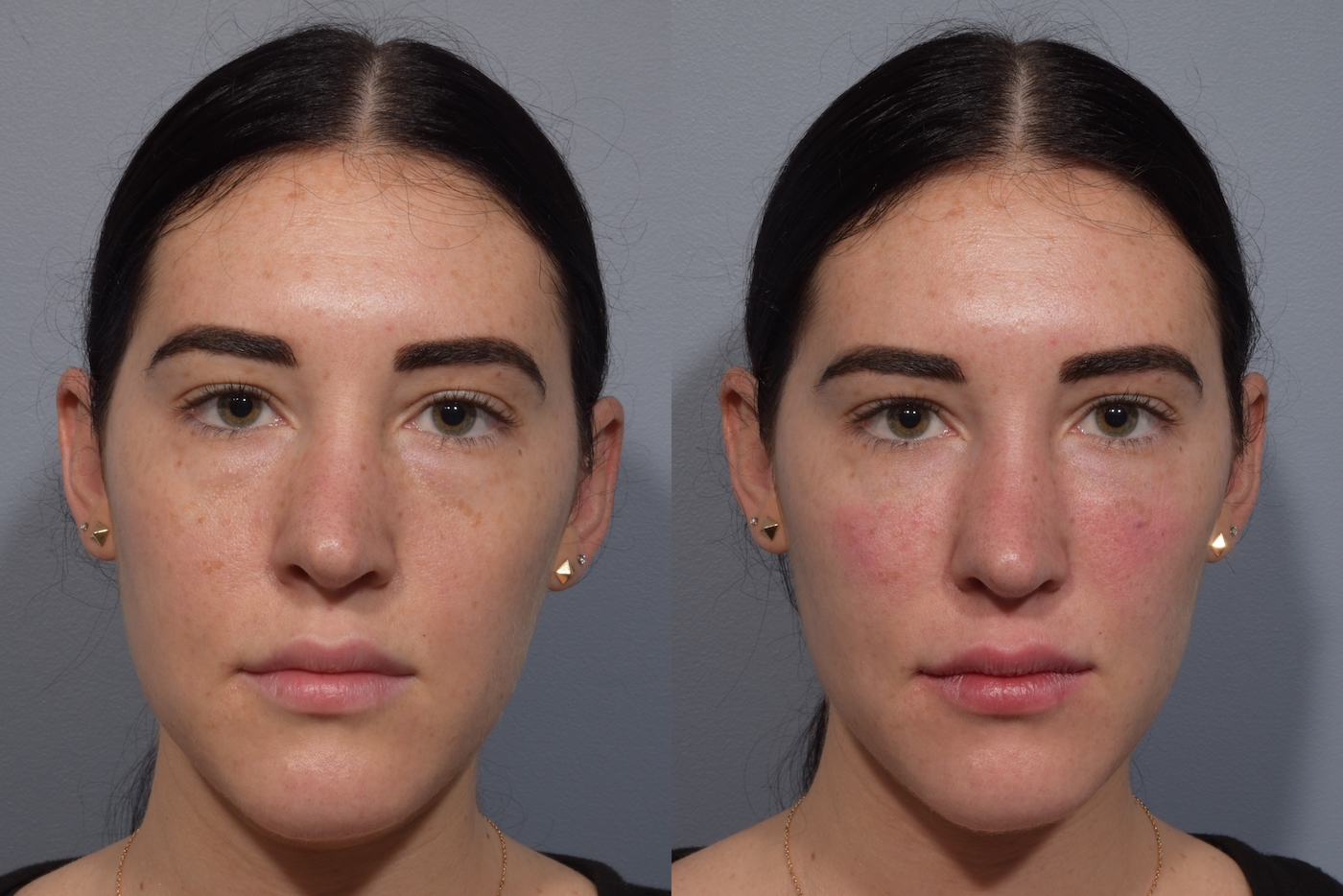 patient before and after tear trough filler