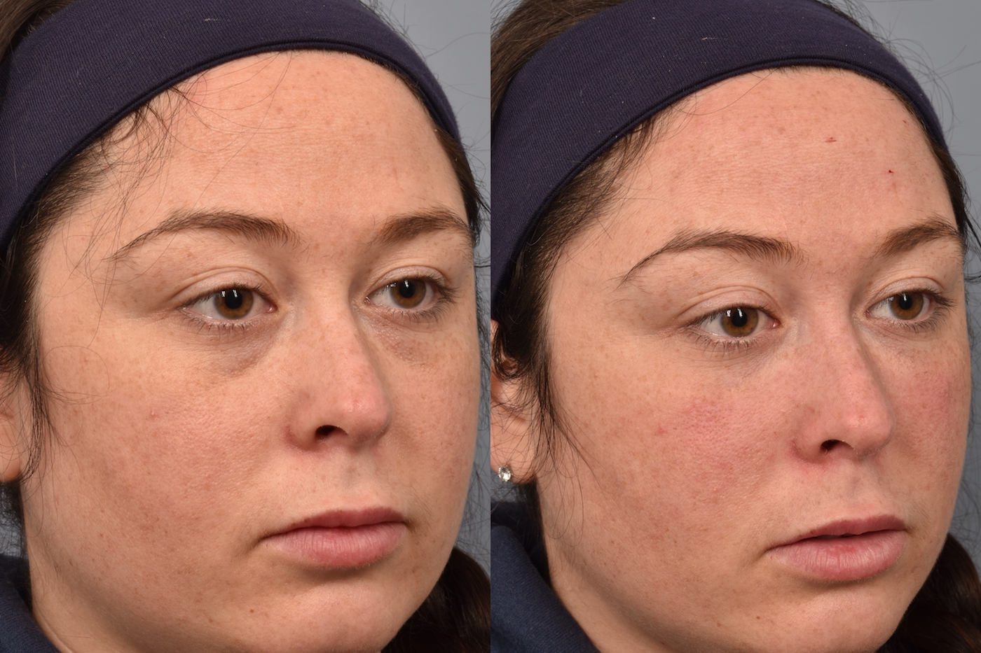 patient before and after tear trough filler