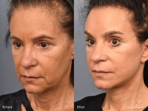 patient before and after facelift