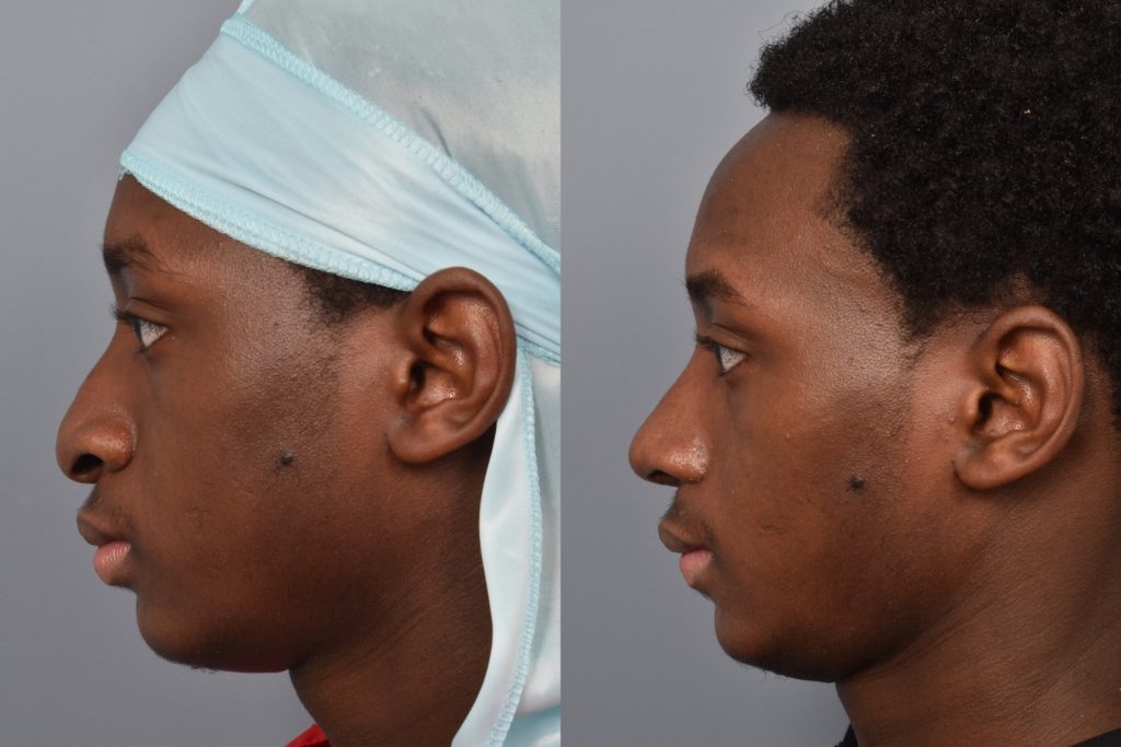 patient before and after alarplasty