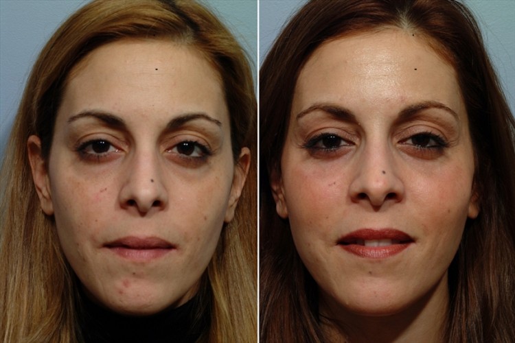 patient before and after cheek implants