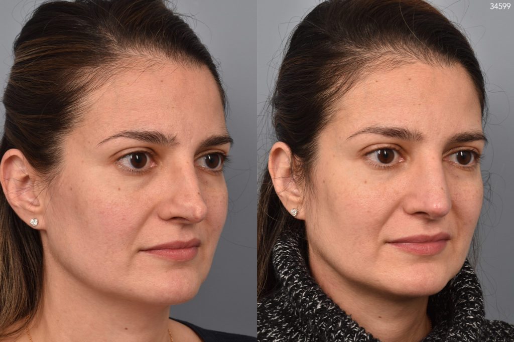 before and after revision rhinoplasty photos of female patient