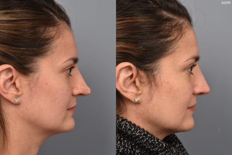 before and after revision rhinoplasty photos of female patient