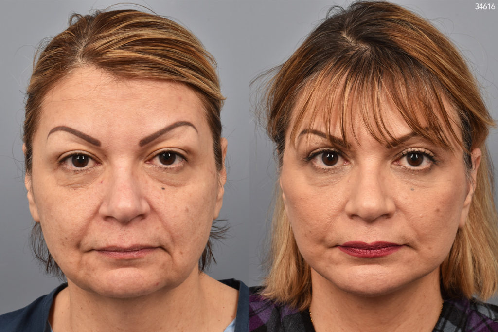 patient before and after facelift, chin implant, upper bleph photos of female