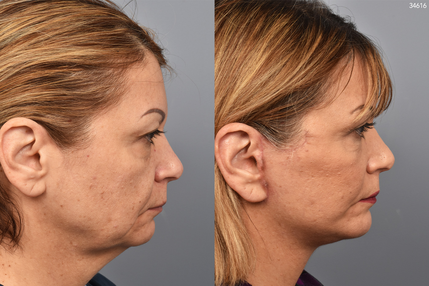 patient before and after facelift, chin implant, upper bleph photos of female