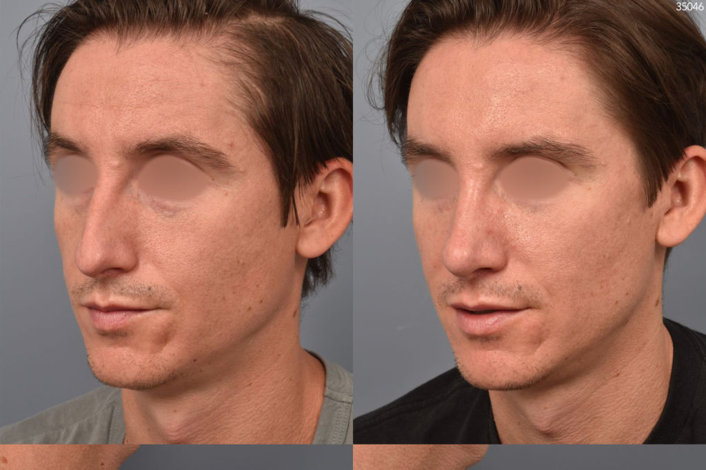 male patient before and after rhinoplasty