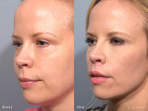 Female showing before and after results from a surgical lip lift
