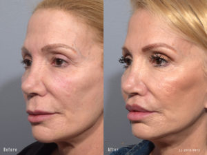 Female showing before and after results from a surgical lip lift