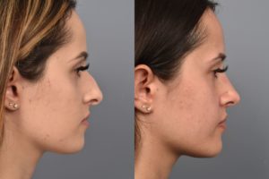 before and after rhinoplasty photos of female patient