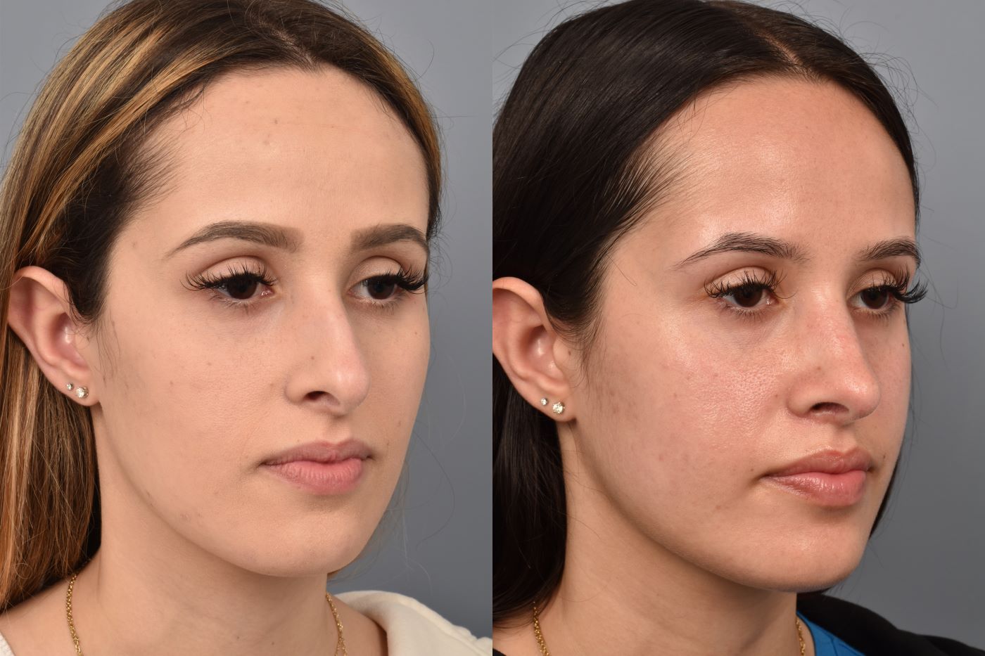 before and after rhinoplasty photos of female patient