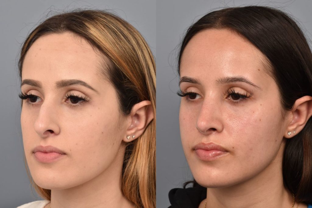 before and after rhinoplasty photos of female patient