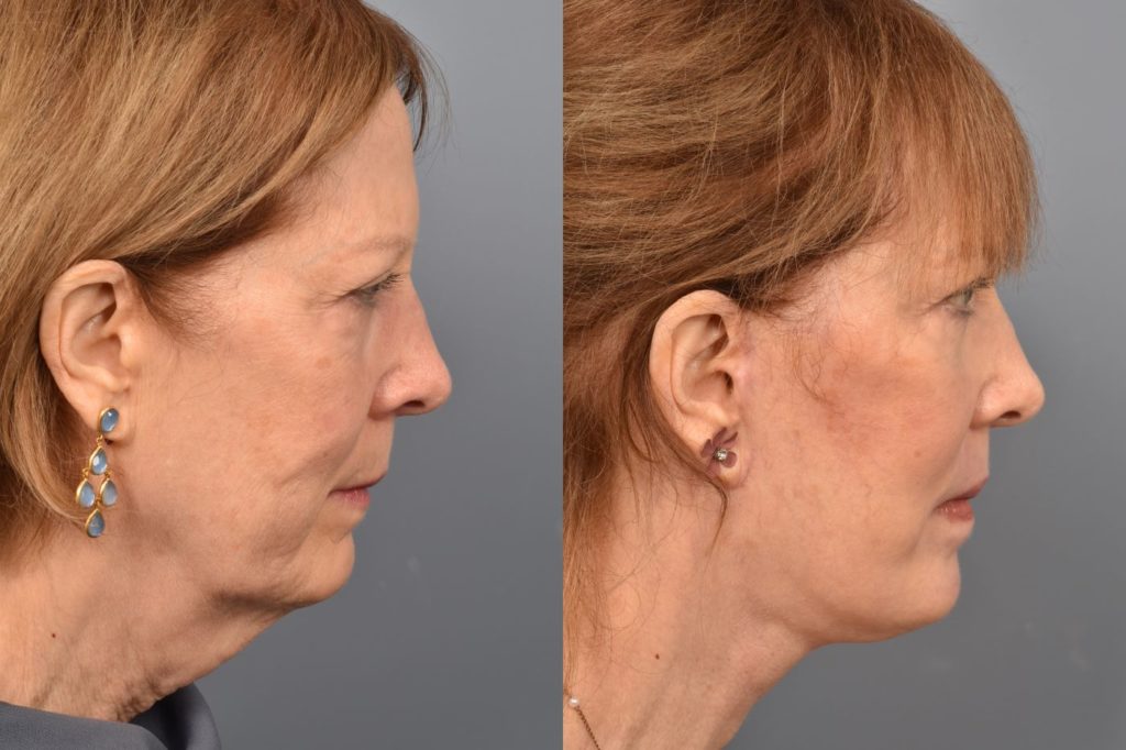 Female patient showing before and after results from a surgical facelift
