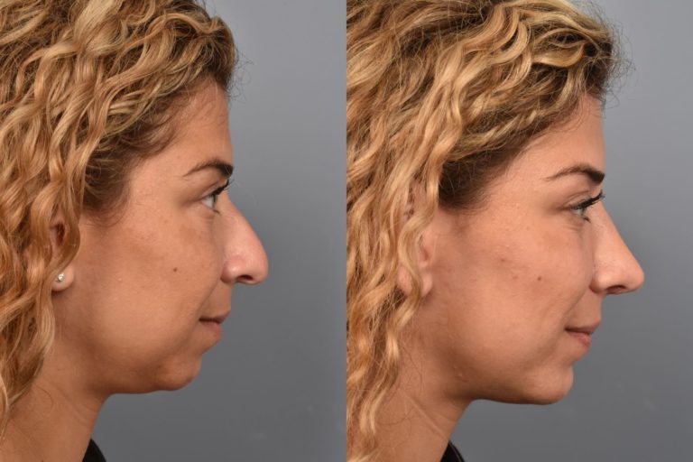 Female before and after rhinoplasty