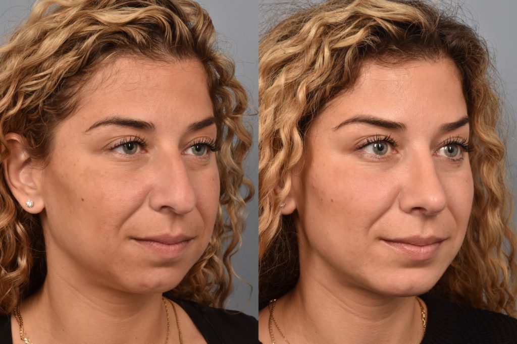 Female before and after rhinoplasty