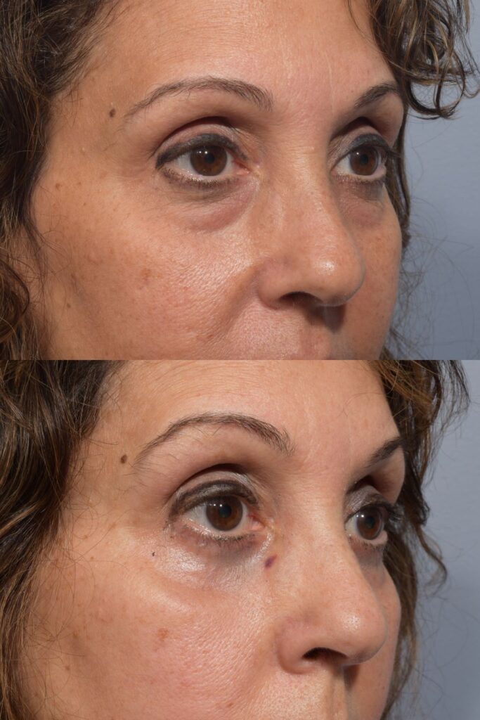 Photo of female before and after blepharoplasty