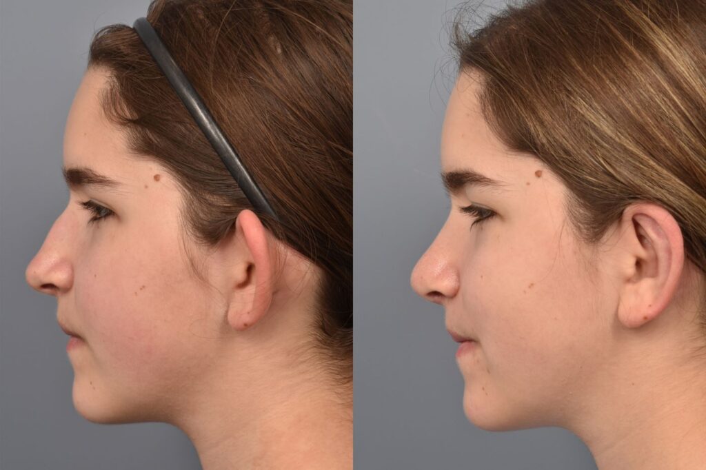 Photo of teenage female before and after rhinoplasty