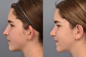Photo of teenage female before and after rhinoplasty