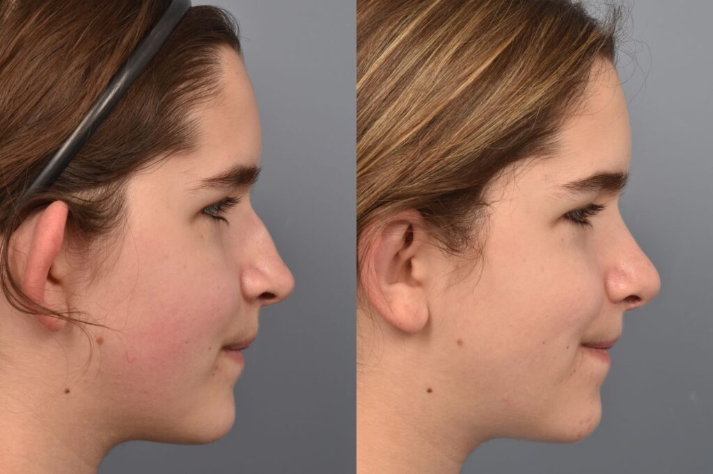 Photo of teenage female before and after rhinoplasty