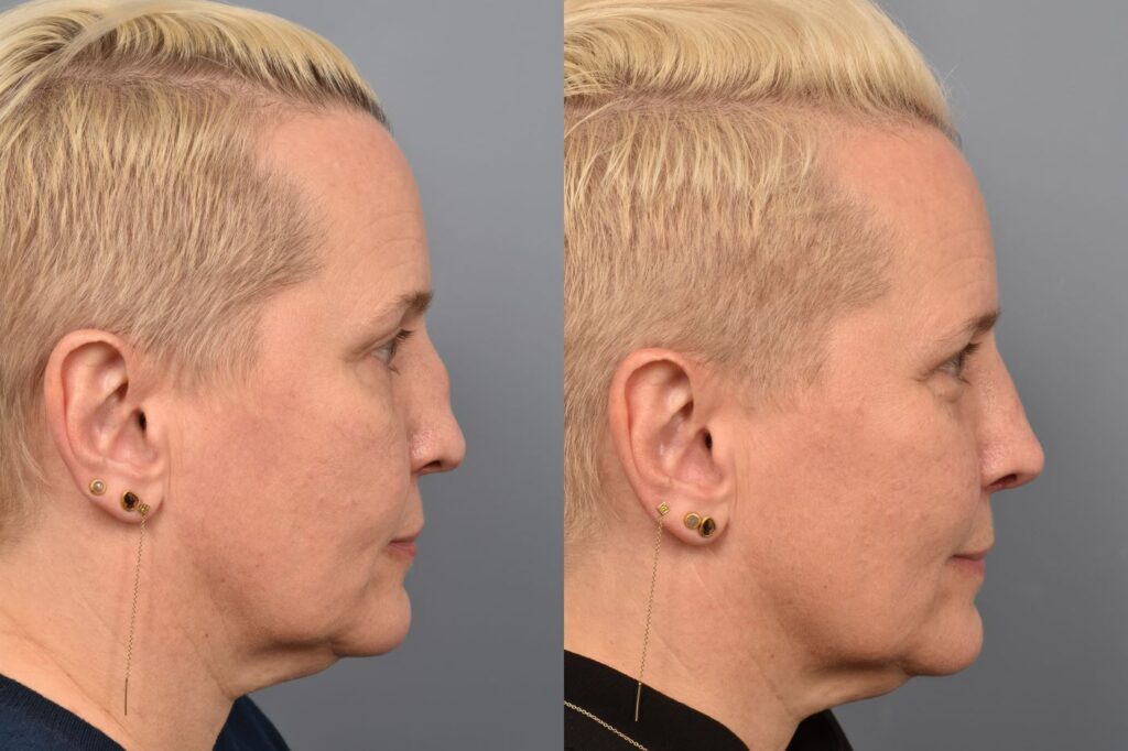 Photo of female before and after revision rhinoplasty