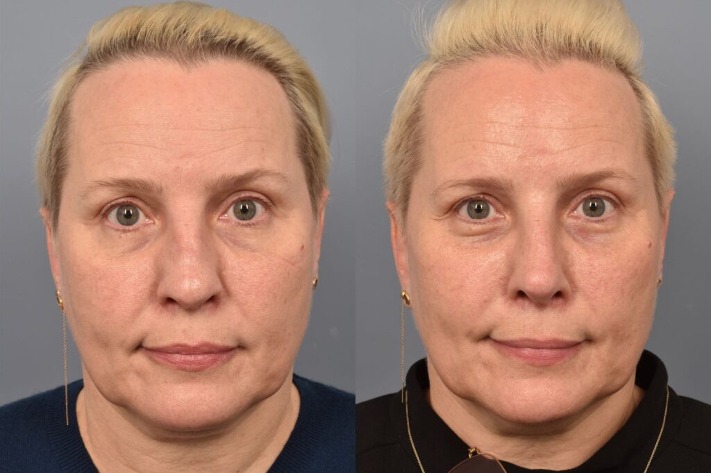 Photo of female before and after revision rhinoplasty