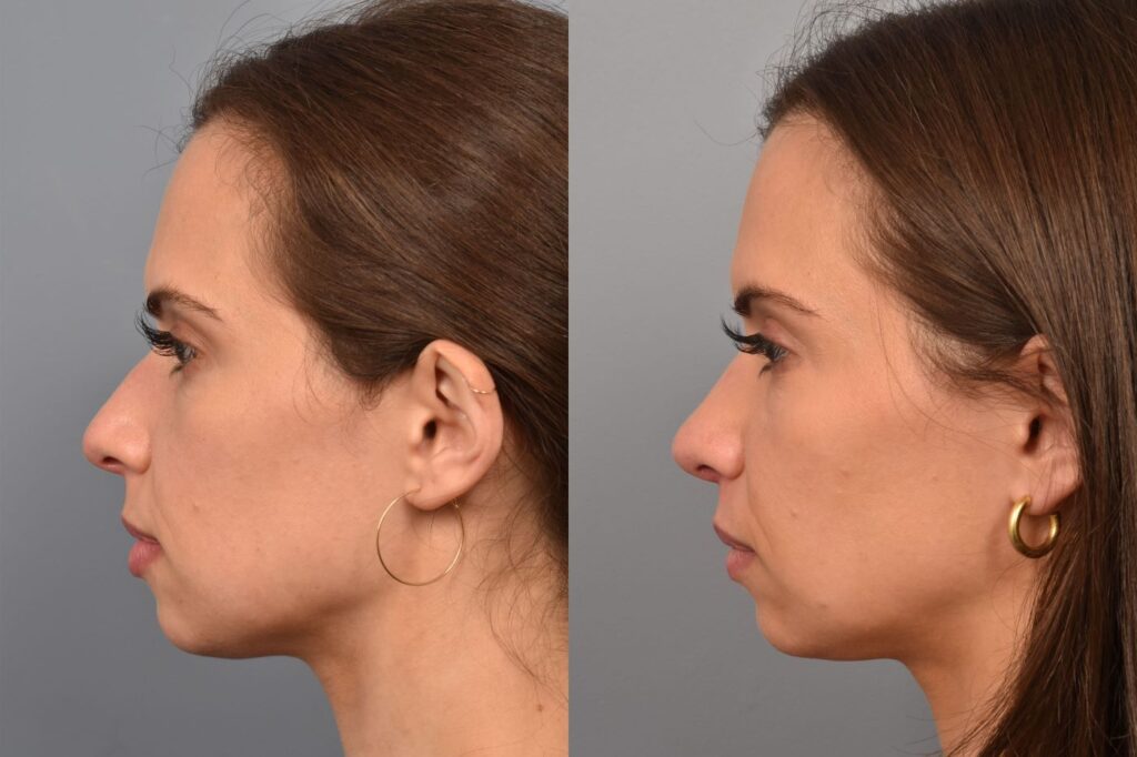Photo of female before and after rhinoplasty