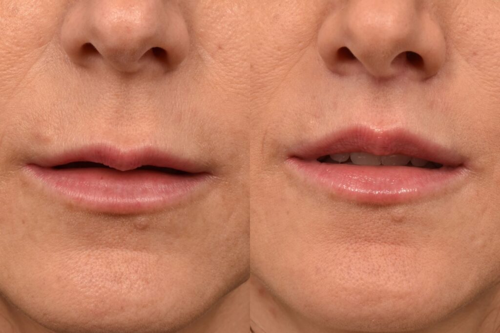 Photo of female before and after a lip lift