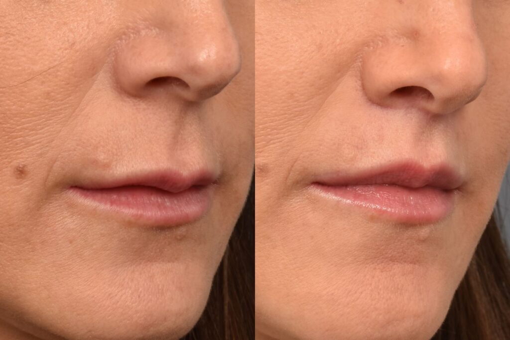 Photo of female before and after a lip lift