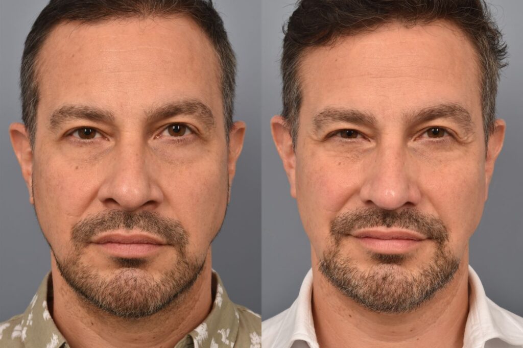 Photo of male before and after revision rhinoplasty